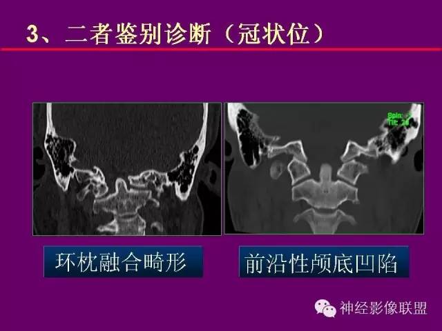 【PPT】颅底重要CT解剖及其临床意义
