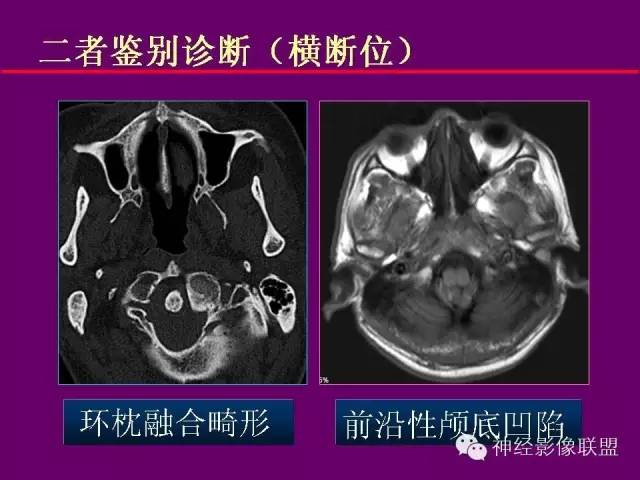 【PPT】颅底重要CT解剖及其临床意义