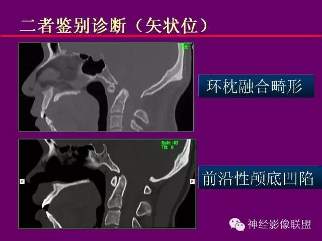 【PPT】颅底重要CT解剖及其临床意义