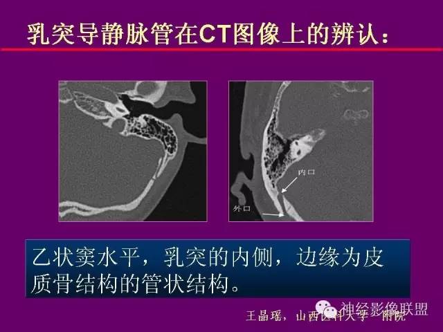 【PPT】颅底重要CT解剖及其临床意义