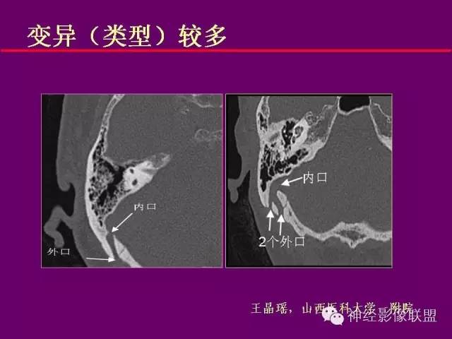 【PPT】颅底重要CT解剖及其临床意义