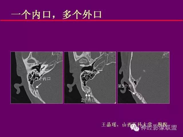 【PPT】颅底重要CT解剖及其临床意义