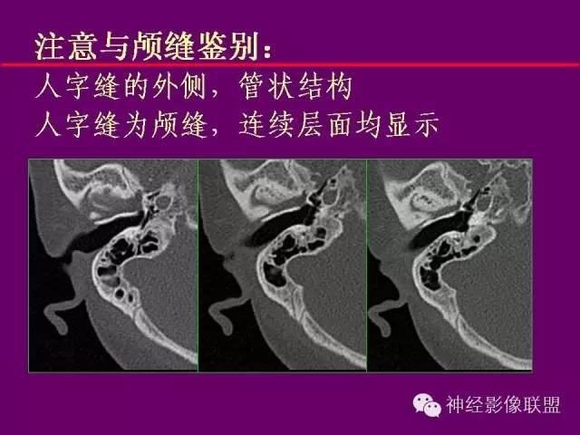 【PPT】颅底重要CT解剖及其临床意义