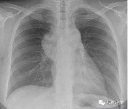 【病例】原发胸腺淋巴瘤1例CT影像表现