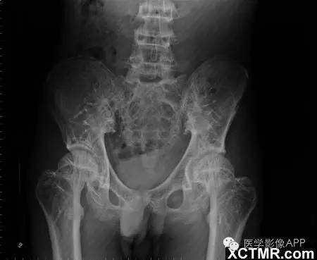【病例】条纹状骨病1例X线影像诊断分析 【病例】条纹状骨病1例X线影像诊断分析