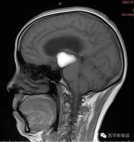 【病例】颅咽管瘤1例MR影像表现
