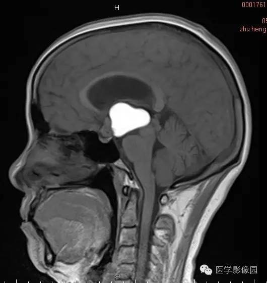 【病例】颅咽管瘤1例MR影像表现 【病例】颅咽管瘤1例MR影像表现