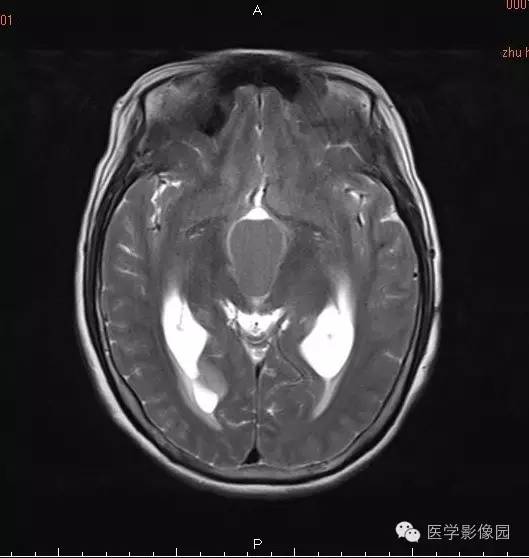 【病例】颅咽管瘤1例MR影像表现 【病例】颅咽管瘤1例MR影像表现