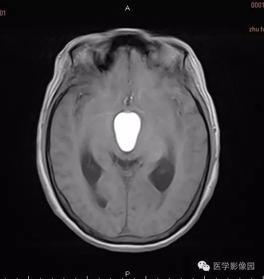 【病例】颅咽管瘤1例MR影像表现 【病例】颅咽管瘤1例MR影像表现