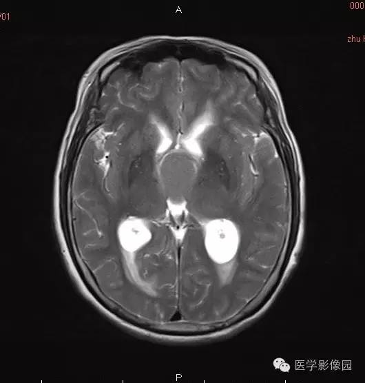 【病例】颅咽管瘤1例MR影像表现 【病例】颅咽管瘤1例MR影像表现