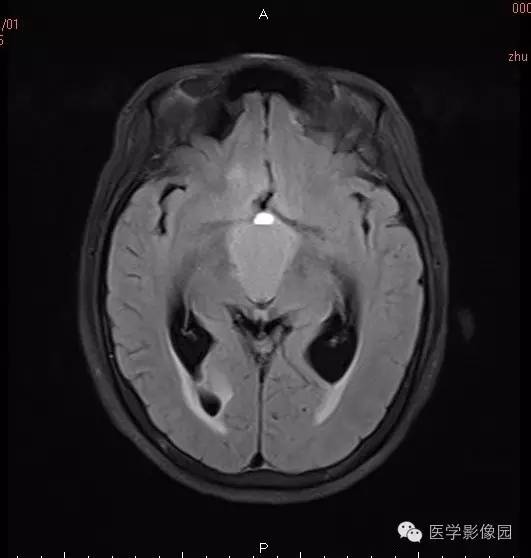 【病例】颅咽管瘤1例MR影像表现 【病例】颅咽管瘤1例MR影像表现