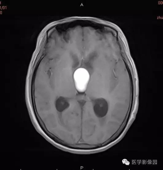 【病例】颅咽管瘤1例MR影像表现 【病例】颅咽管瘤1例MR影像表现