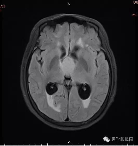 【病例】颅咽管瘤1例MR影像表现 【病例】颅咽管瘤1例MR影像表现