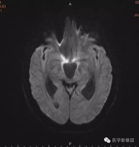 【病例】颅咽管瘤1例MR影像表现 【病例】颅咽管瘤1例MR影像表现