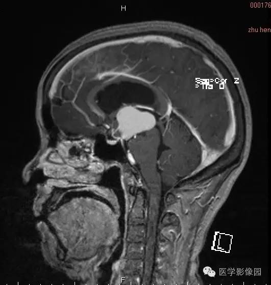 【病例】颅咽管瘤1例MR影像表现 【病例】颅咽管瘤1例MR影像表现