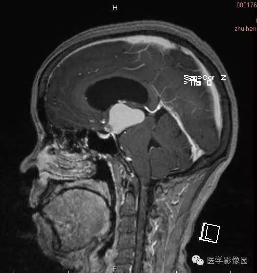 【病例】颅咽管瘤1例MR影像表现 【病例】颅咽管瘤1例MR影像表现