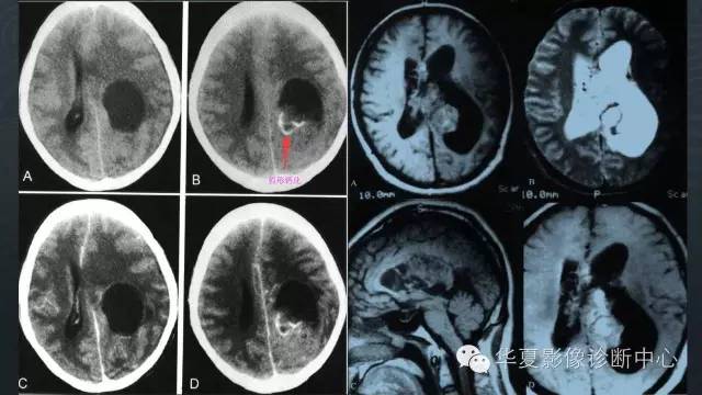 【PPT】脑室常见实质性占位病变的诊断