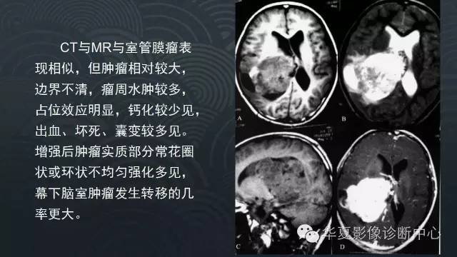 【PPT】脑室常见实质性占位病变的诊断