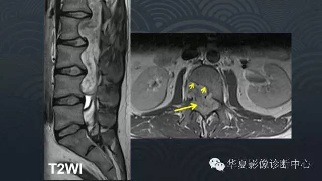 【PPT】脑室常见实质性占位病变的诊断