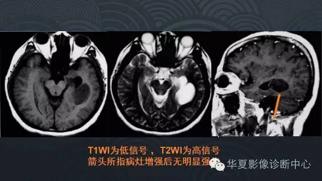 【PPT】脑室常见实质性占位病变的诊断
