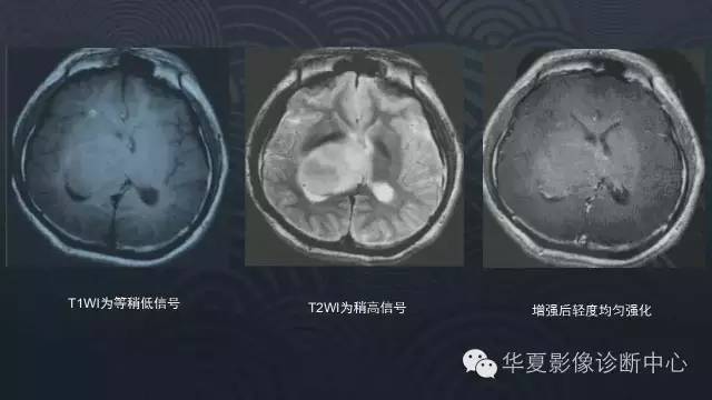 【PPT】脑室常见实质性占位病变的诊断