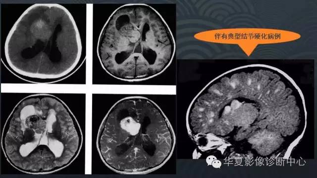 【PPT】脑室常见实质性占位病变的诊断