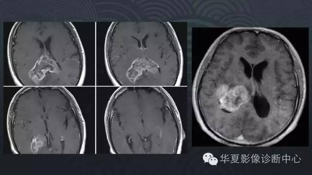 【PPT】脑室常见实质性占位病变的诊断