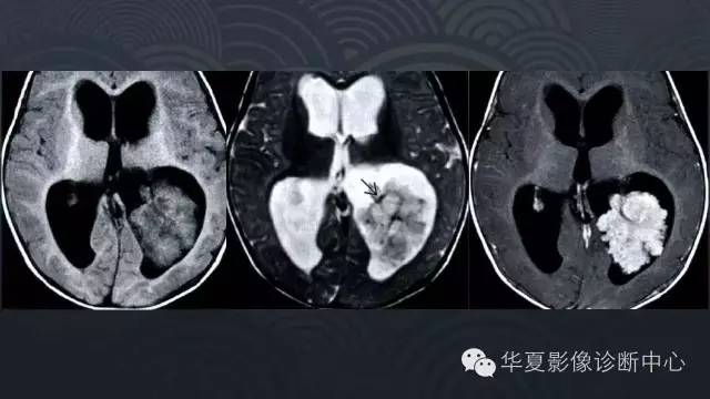 【PPT】脑室常见实质性占位病变的诊断