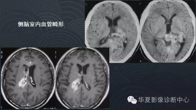 【PPT】脑室常见实质性占位病变的诊断
