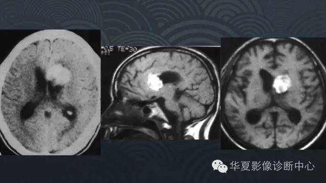 【PPT】脑室常见实质性占位病变的诊断
