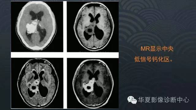 【PPT】脑室常见实质性占位病变的诊断