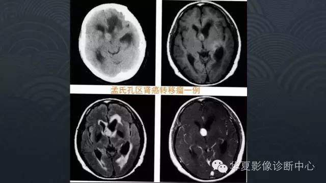 【PPT】脑室常见实质性占位病变的诊断