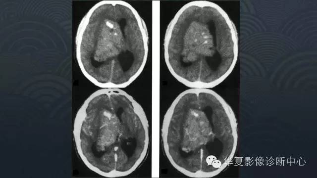 【PPT】脑室常见实质性占位病变的诊断