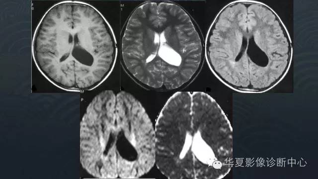 【PPT】脑室系统常见囊性病变的诊断