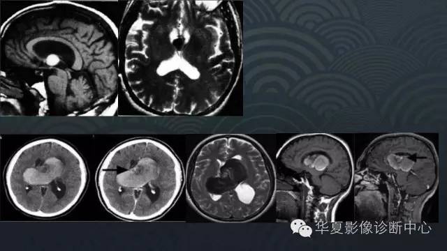 【PPT】脑室系统常见囊性病变的诊断