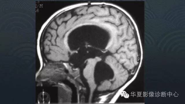 【PPT】脑室系统常见囊性病变的诊断