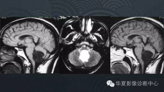 【PPT】脑室系统常见囊性病变的诊断