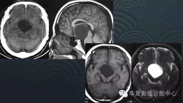 【PPT】脑室系统常见囊性病变的诊断
