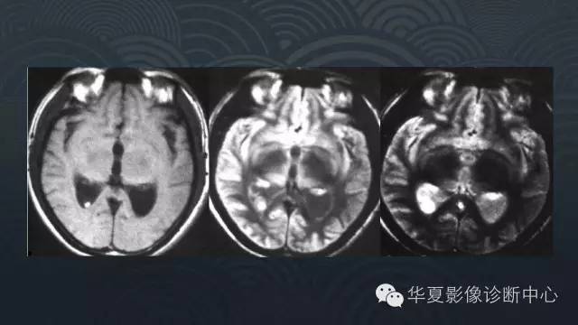 【PPT】脑室系统常见囊性病变的诊断