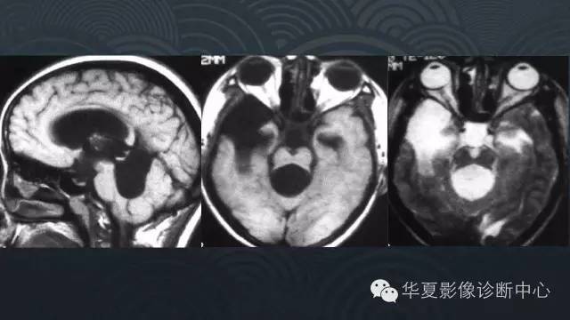 【PPT】脑室系统常见囊性病变的诊断