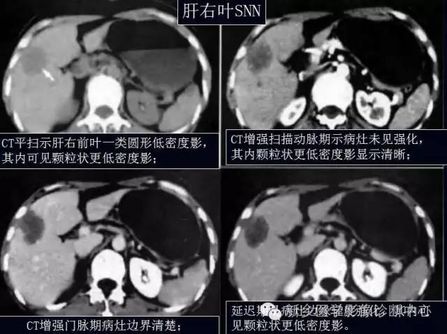 孤立性肝脏坏死结节