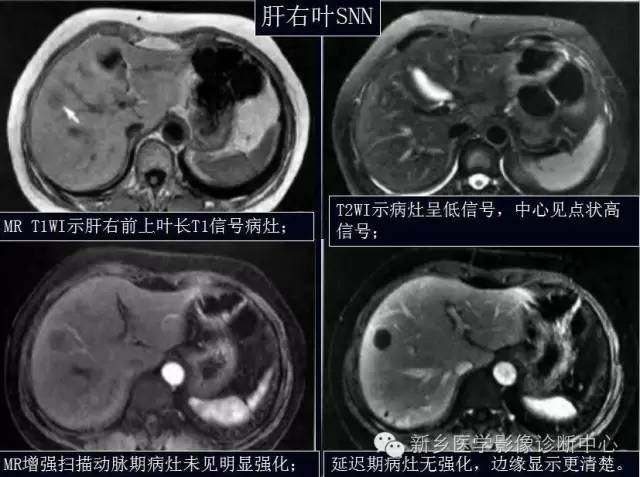 孤立性肝脏坏死结节 孤立性肝脏坏死结节