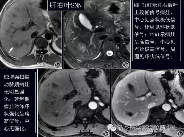 孤立性肝脏坏死结节 孤立性肝脏坏死结节
