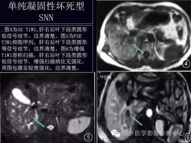 孤立性肝脏坏死结节 孤立性肝脏坏死结节