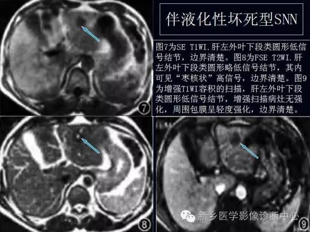 孤立性肝脏坏死结节 孤立性肝脏坏死结节