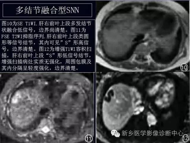 孤立性肝脏坏死结节 孤立性肝脏坏死结节