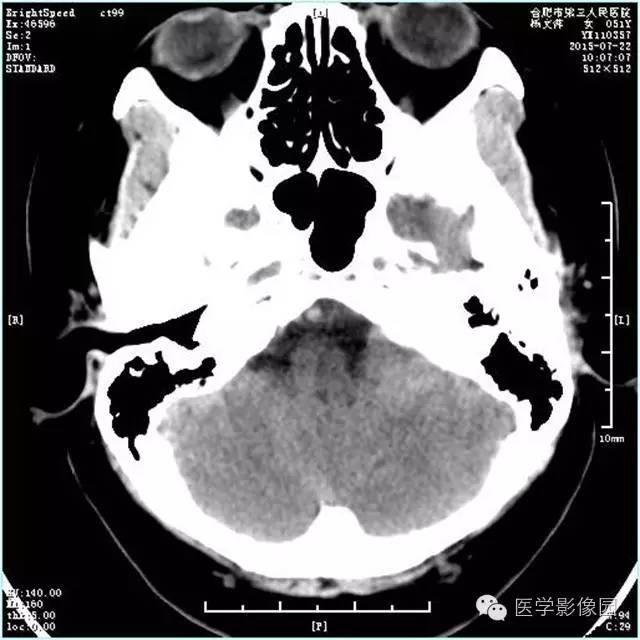 【病例】左侧桥小脑角转移性腺癌侵犯听神经1例CT及MR影像表现