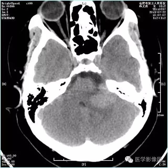 【病例】左侧桥小脑角转移性腺癌侵犯听神经1例CT及MR影像表现 【病例】左侧桥小脑角转移性腺癌侵犯听神经1例CT及MR影像表现