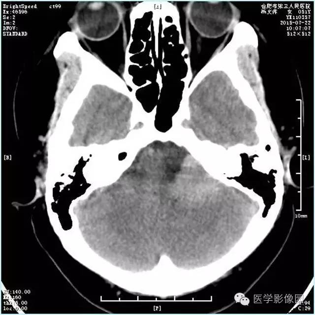 【病例】左侧桥小脑角转移性腺癌侵犯听神经1例CT及MR影像表现 【病例】左侧桥小脑角转移性腺癌侵犯听神经1例CT及MR影像表现