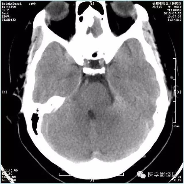 【病例】左侧桥小脑角转移性腺癌侵犯听神经1例CT及MR影像表现 【病例】左侧桥小脑角转移性腺癌侵犯听神经1例CT及MR影像表现